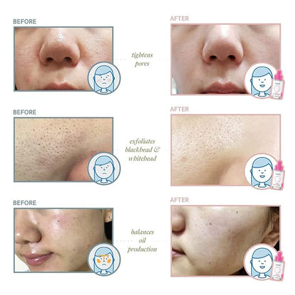 beplain 0.2% Salicylic Acid Serum | BHA Gentle Exfoliating Serum | Pore Refining, Oil & AcneControl | 1.01fl.oz | Korean skin care