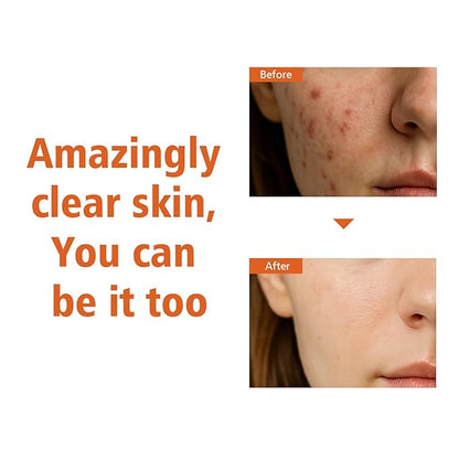 Salicylic Acid Serum for Face, Skin Clearing Serum for Oily, Blemish, Prone Skin, Hydrating Face sérum with Hyaluronic Acid, Vitamin C, Minimize Pores, Clear Acne Marks 30ml