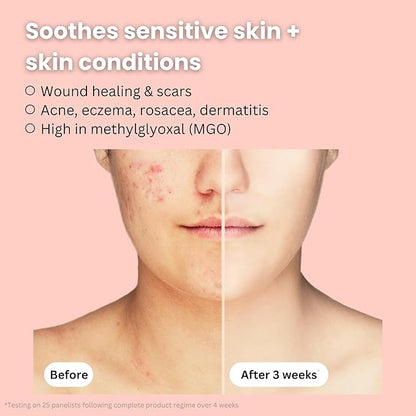Organic Bee Venom + Manuka Honey Face Serum | Hydrating, Resurfacing, Collagen Booster | 2 month supply, 1oz/30ml | Made in New Zealand