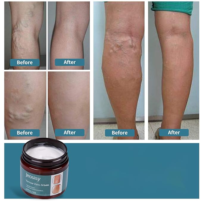 Varicose Vein Cream for Legs -