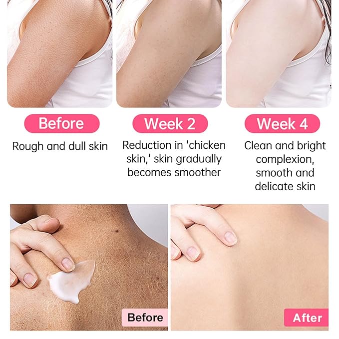 Strawberry Legs Treatment For Women,Bump Eraser