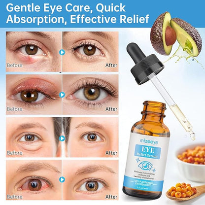 Eye Serum For Chalazion & Blepharitis Treatment, 2 PCS Chalazion Remover For Eyelid Treatment, Eyelid Serum With Avocado Oil, Sea Buckthorn Oil & Caffeine, Relieve Puffiness and Eye Fatigue